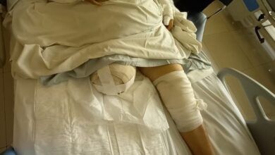 Photo of Perdió su pierna por ataque de pitbull